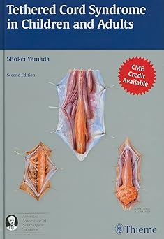 Tethered Cord Syndrome in Children and Adults