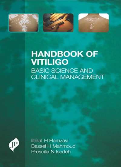 HANDBOOK OF VITILIGO BASIC SCIENCE AND CLINICAL MANAGEMENT