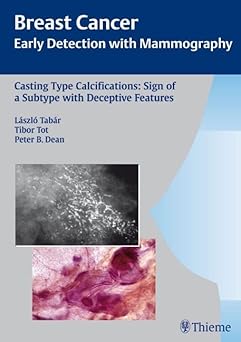 Casting Type Calcifications Sign of a Subtype with