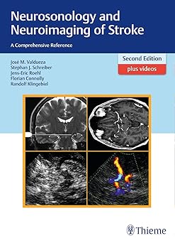 Neurosonology and Neuroimaging of Stroke 2nd Edition