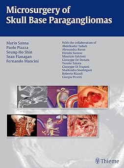 MICROSURGERY OF SKULL BASE PARAGANGLIOMAS