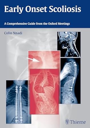 Early Onset Scoliosis A Comprehensive Guide from the Oxford Meetings 1st Ed