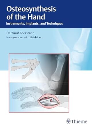 Osteosynthesis of the Hand : Instruments, Implants, and Techniques 1st Edition