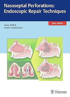 Nasoseptal Perforations: Endoscopic Repair Techniques 1st Edition