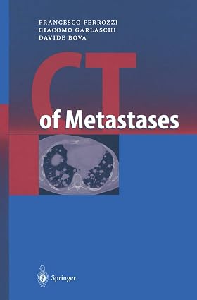 CT OF METASTASES