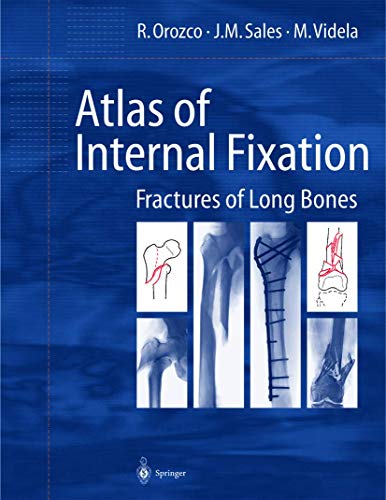 ATLAS OF INTERNAL FIXATION FRACTURES OF LONG BONES