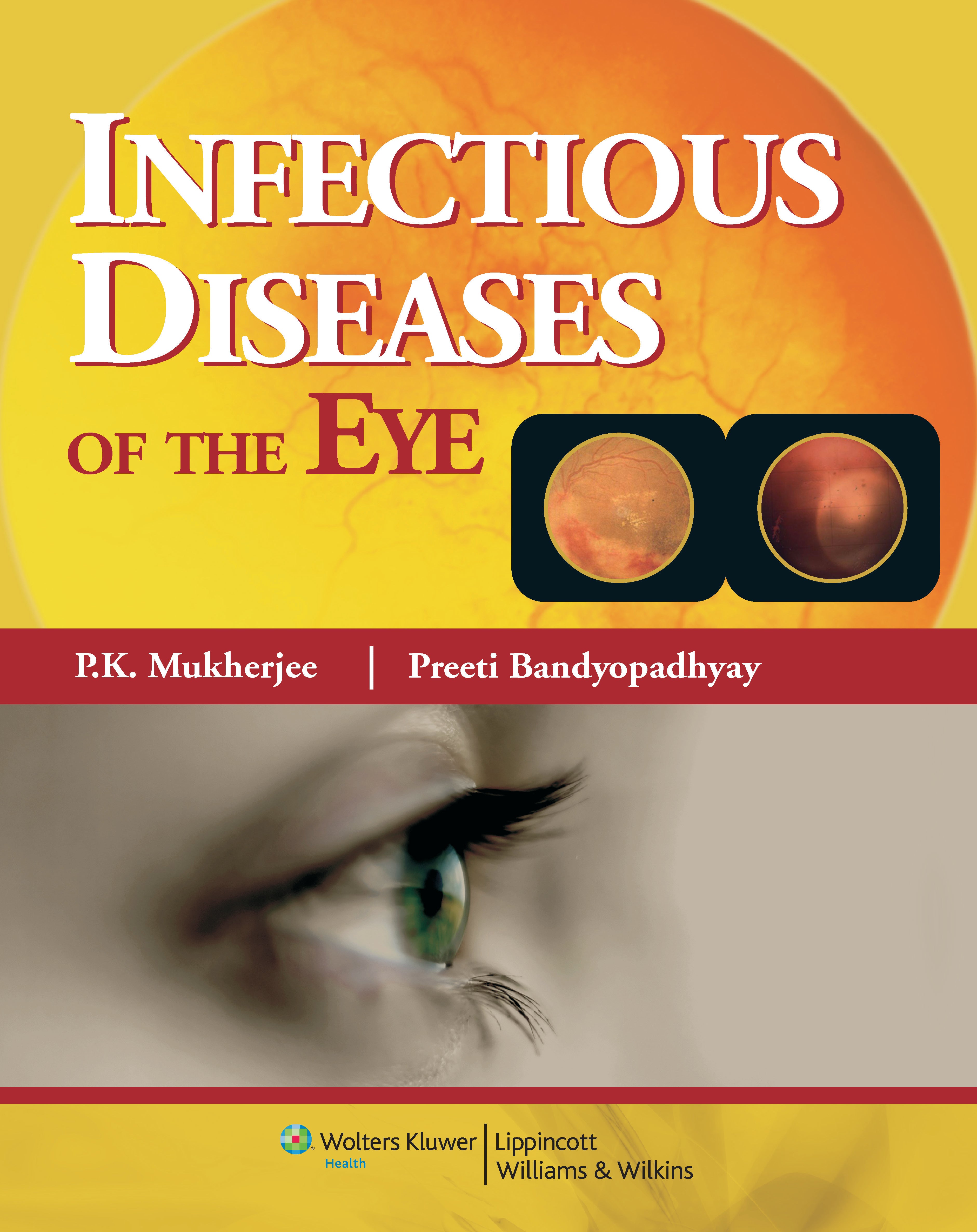 Infectious Diseases of the Eye