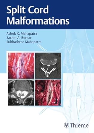 Split Cord Malformations 1st Ed.