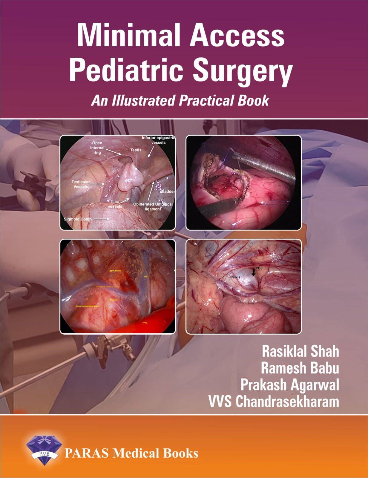 Minimal Access Pediatric Surgery An Illustrated Practical Book