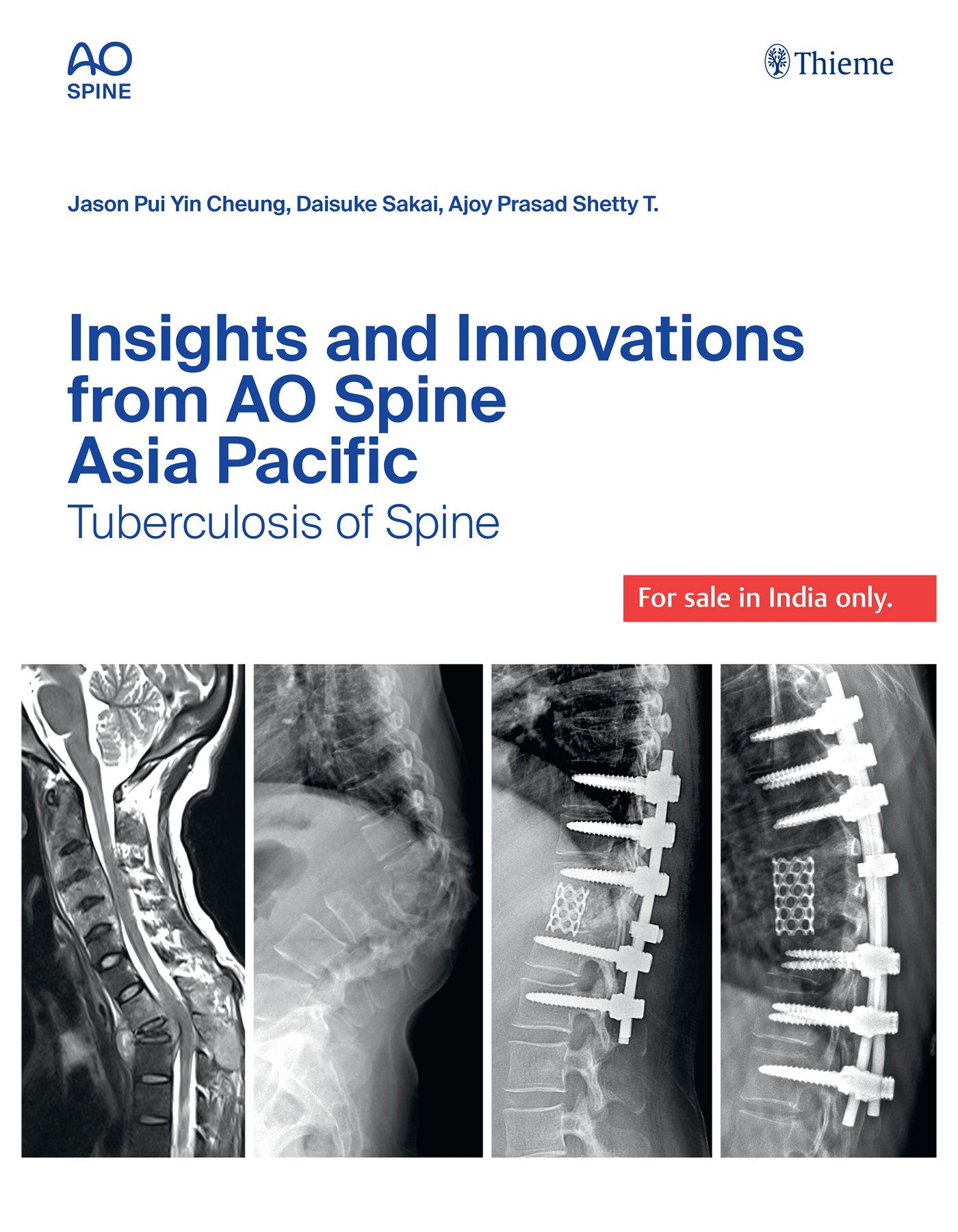 Insights and Innovations from AO Spine Asia Pacific Ossification Disorders