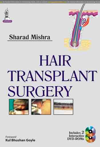 HAIR TRANSPLANT SURGERY