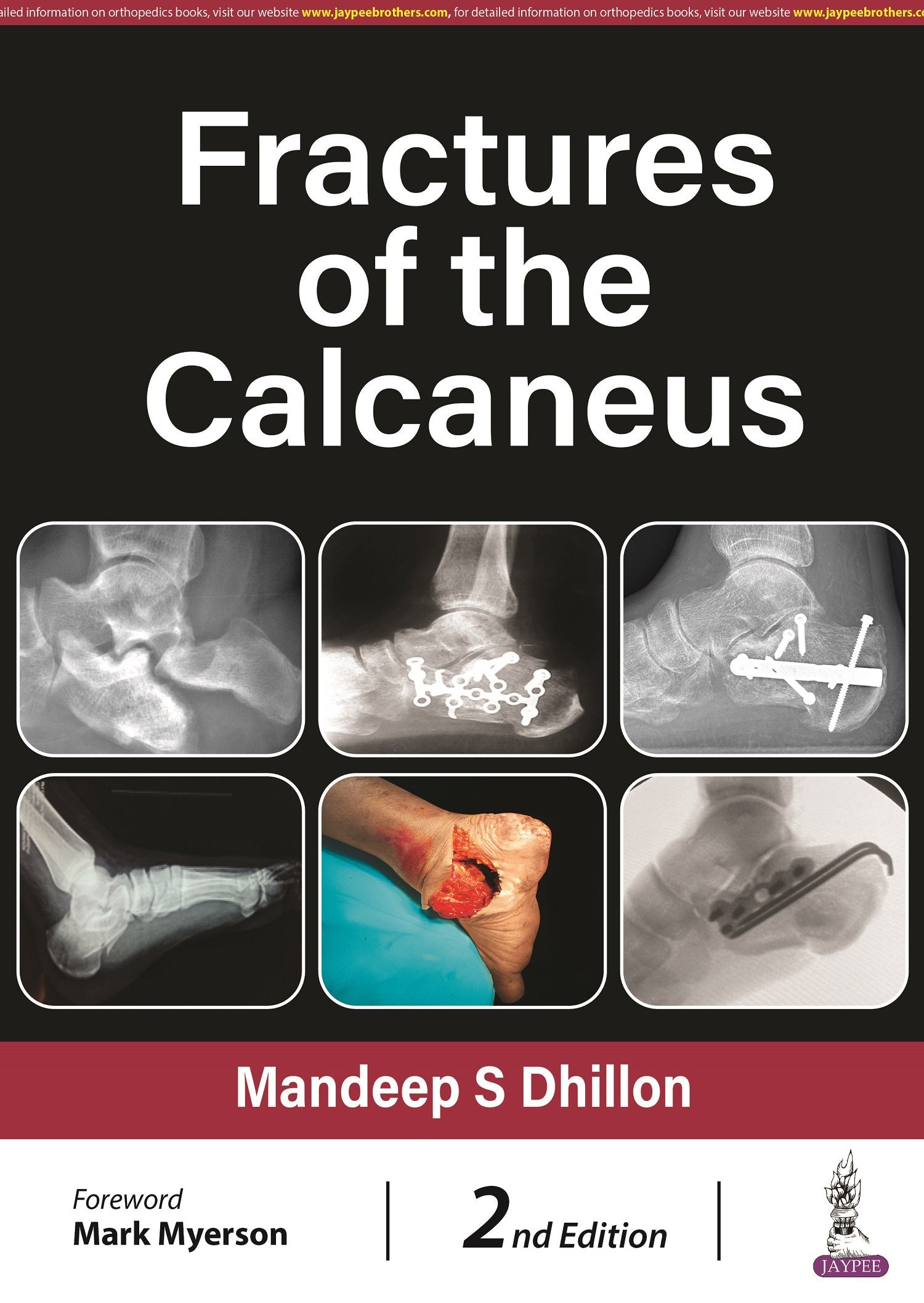 FRACTURES OF THE CALCANEUS