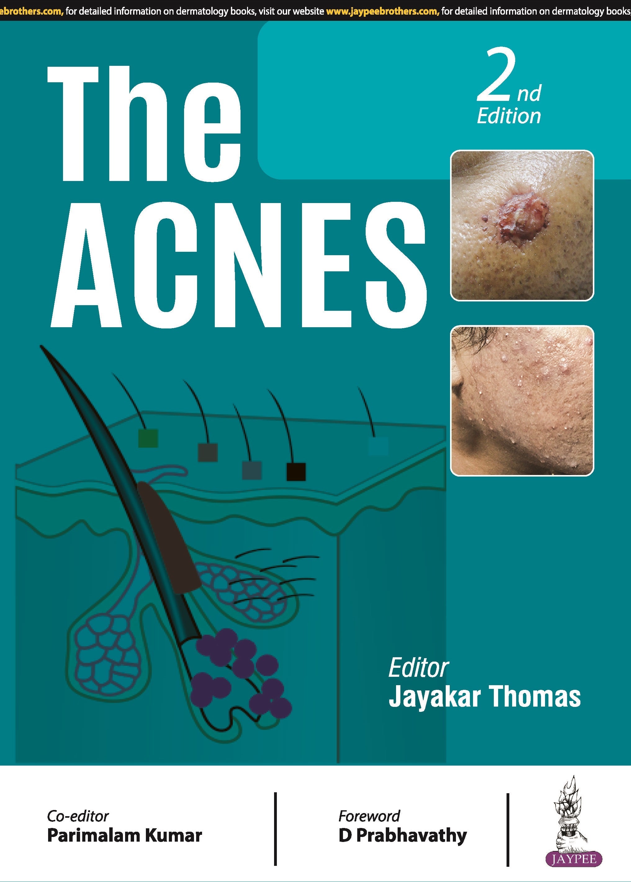 THE ACNES