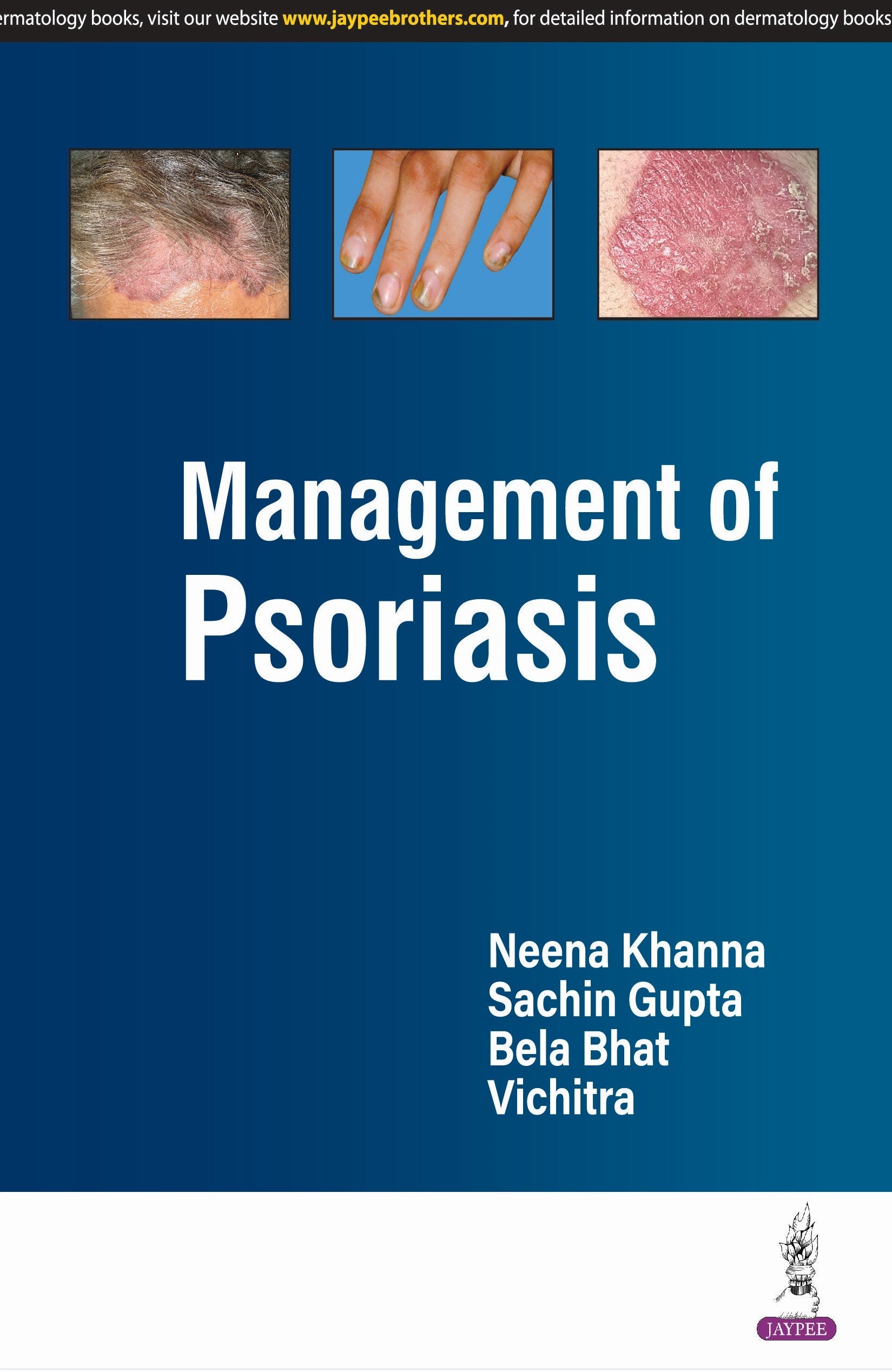 MANAGEMENT OF PSORIASIS
