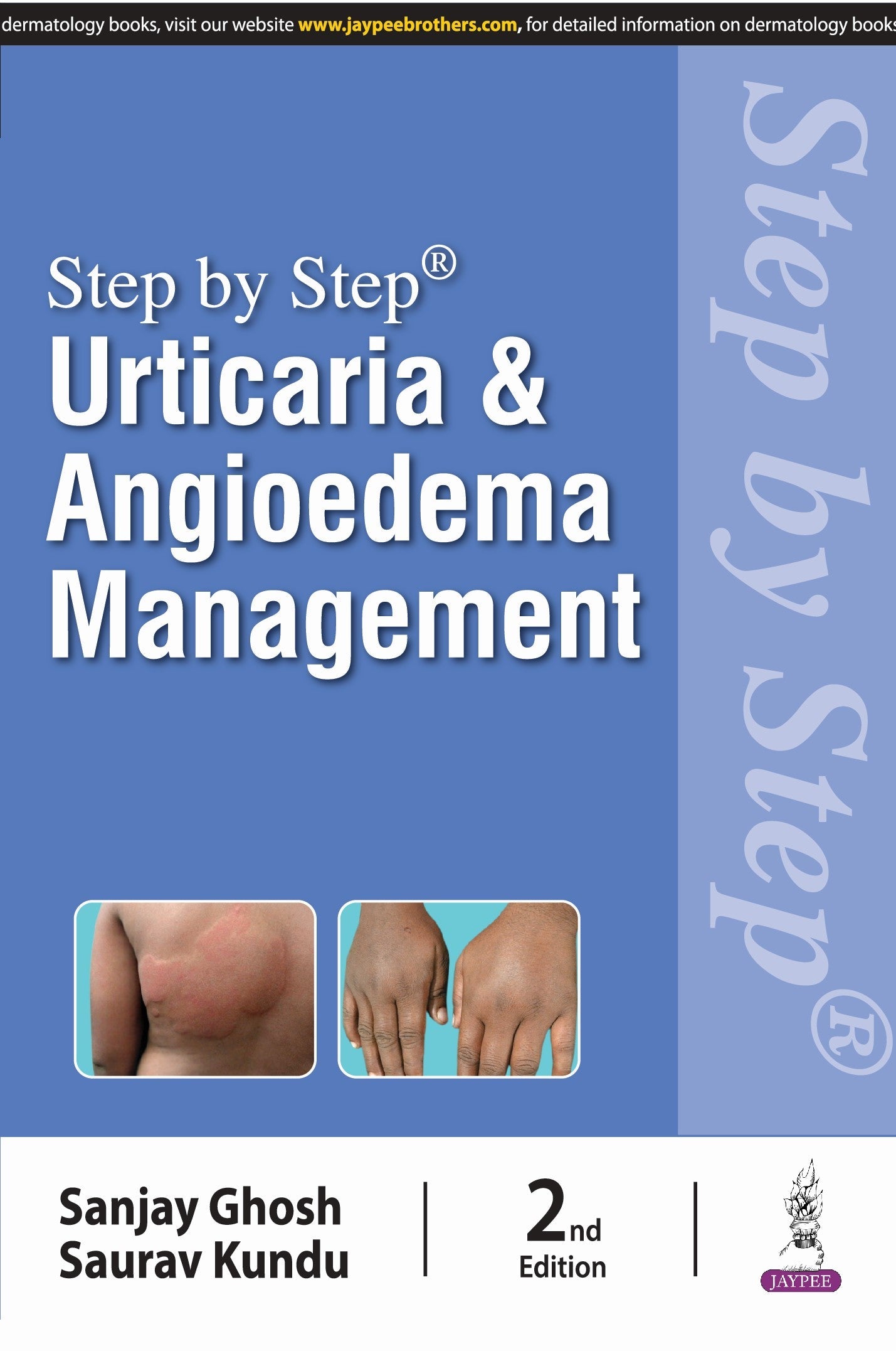 STEP BY STEP URTICARIA AND ANGIOEDEMA MANAGEMENT