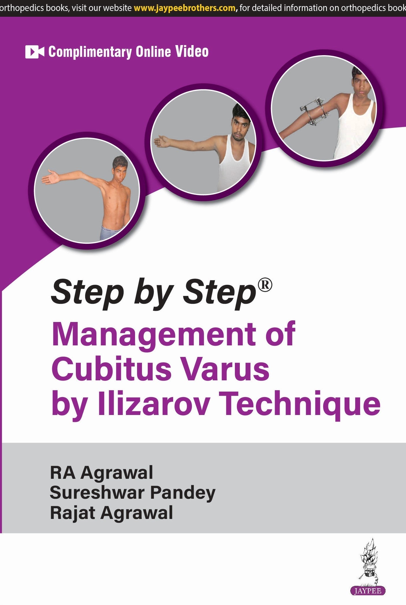 STEP BY STEP MANAGEMENT OF CUBITUS VARUS BY ILIZAROVE TECHNIQUE