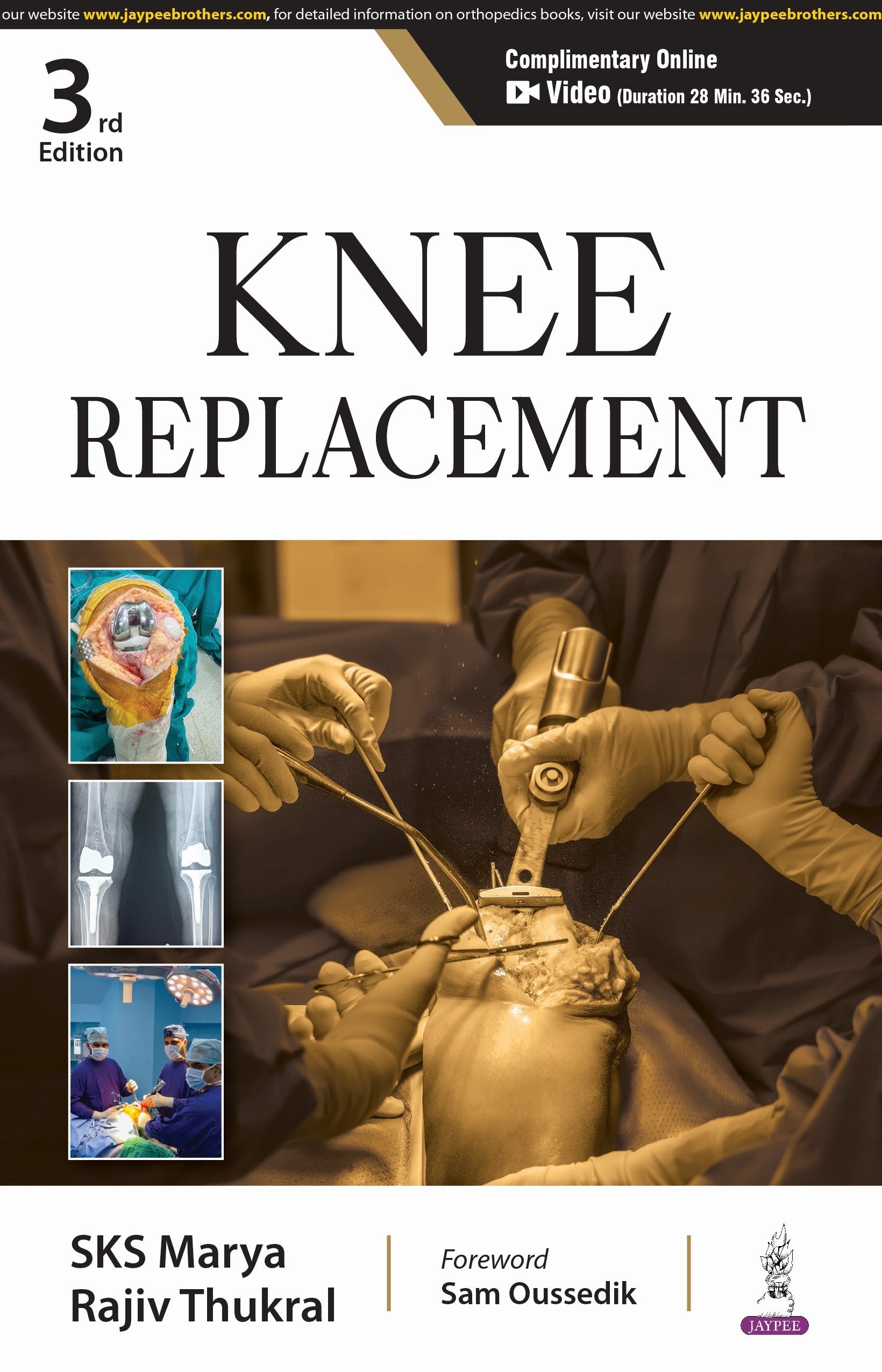 KNEE REPLACEMENT