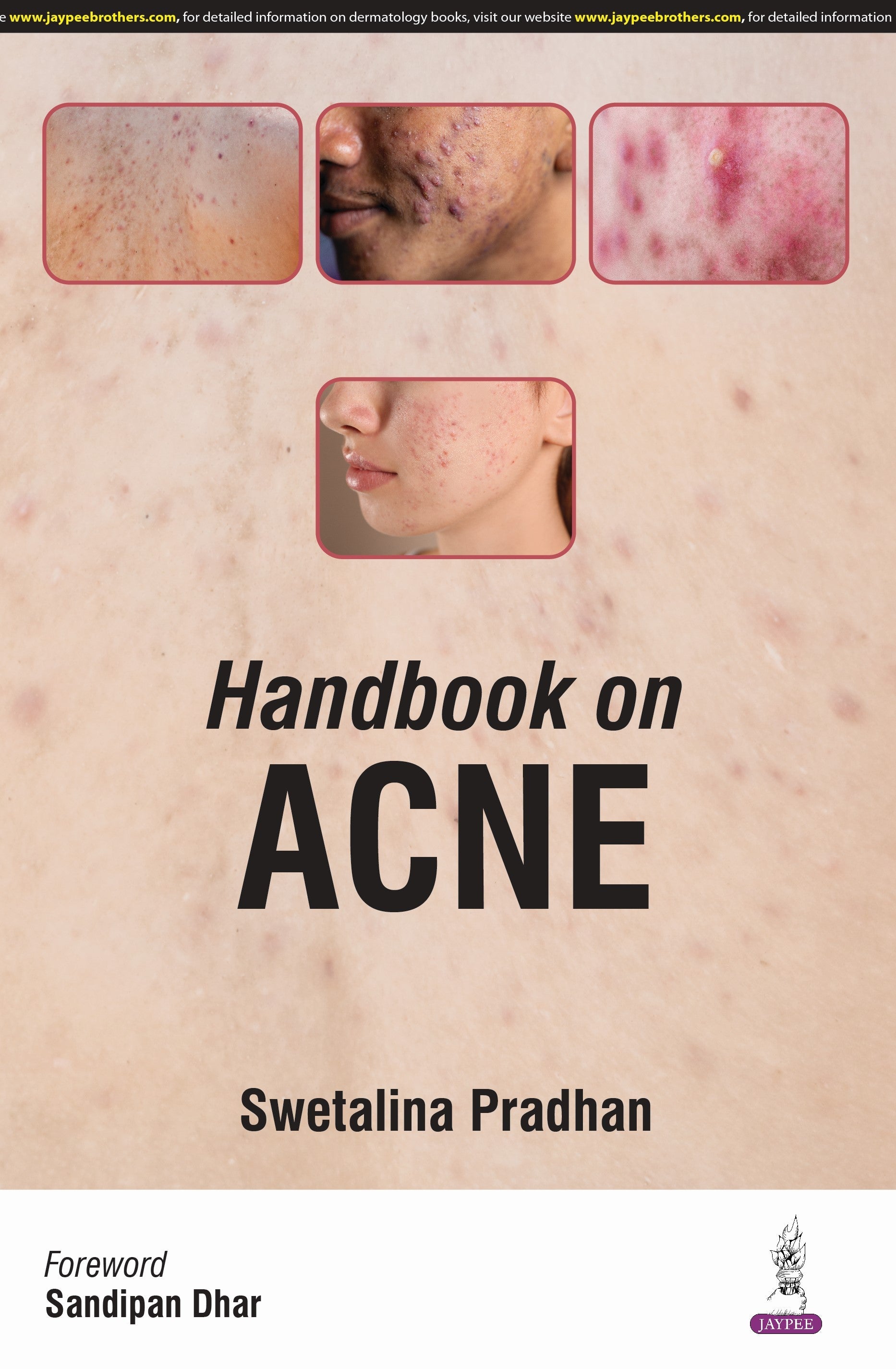 HANDBOOK ON ACNE