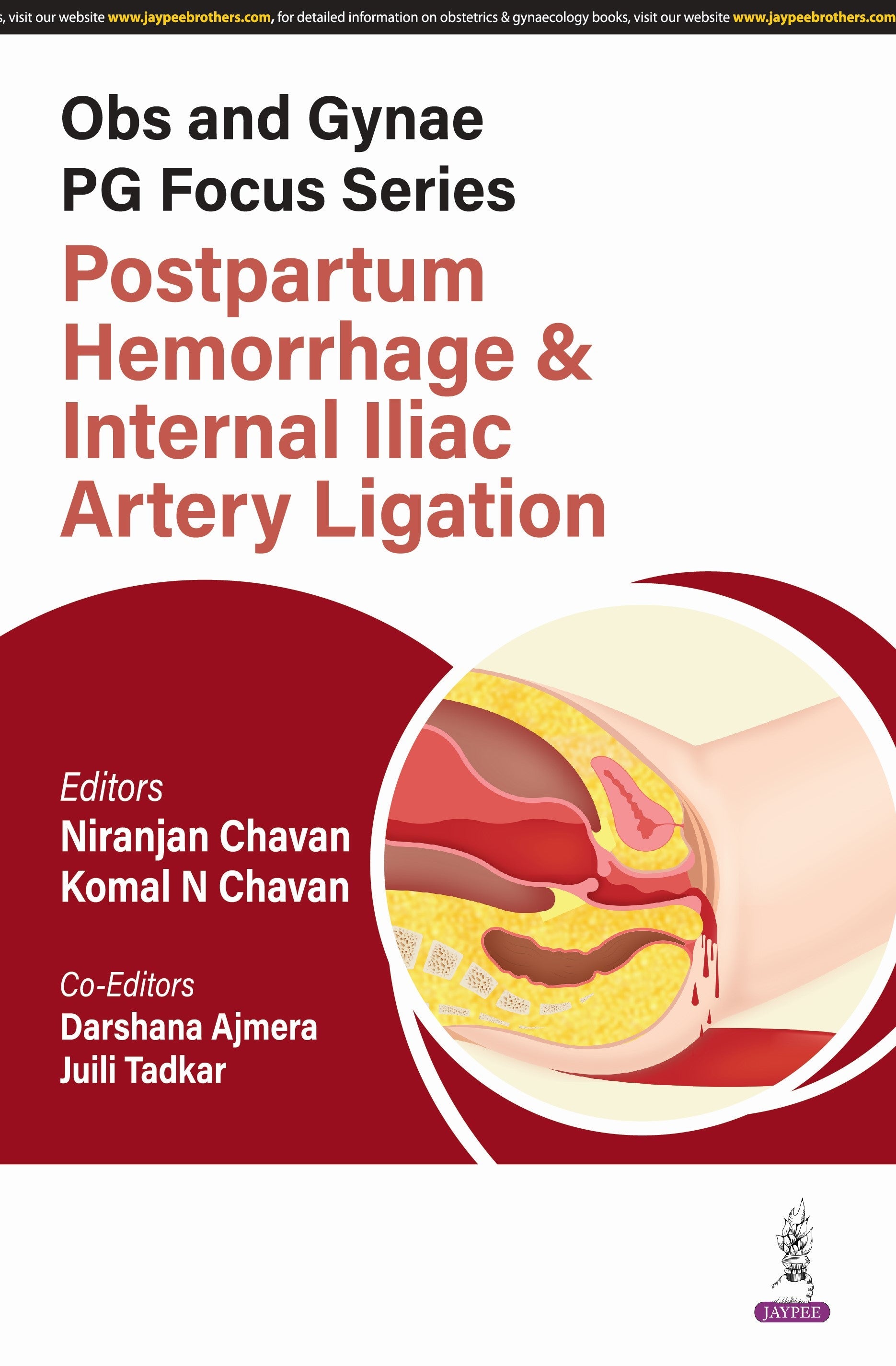OBS AND GYNAE PG FOCUS SERIES POSTPARTUM HEMORRHAGE & INTERNAL ILIAC ARTERY LIGATION