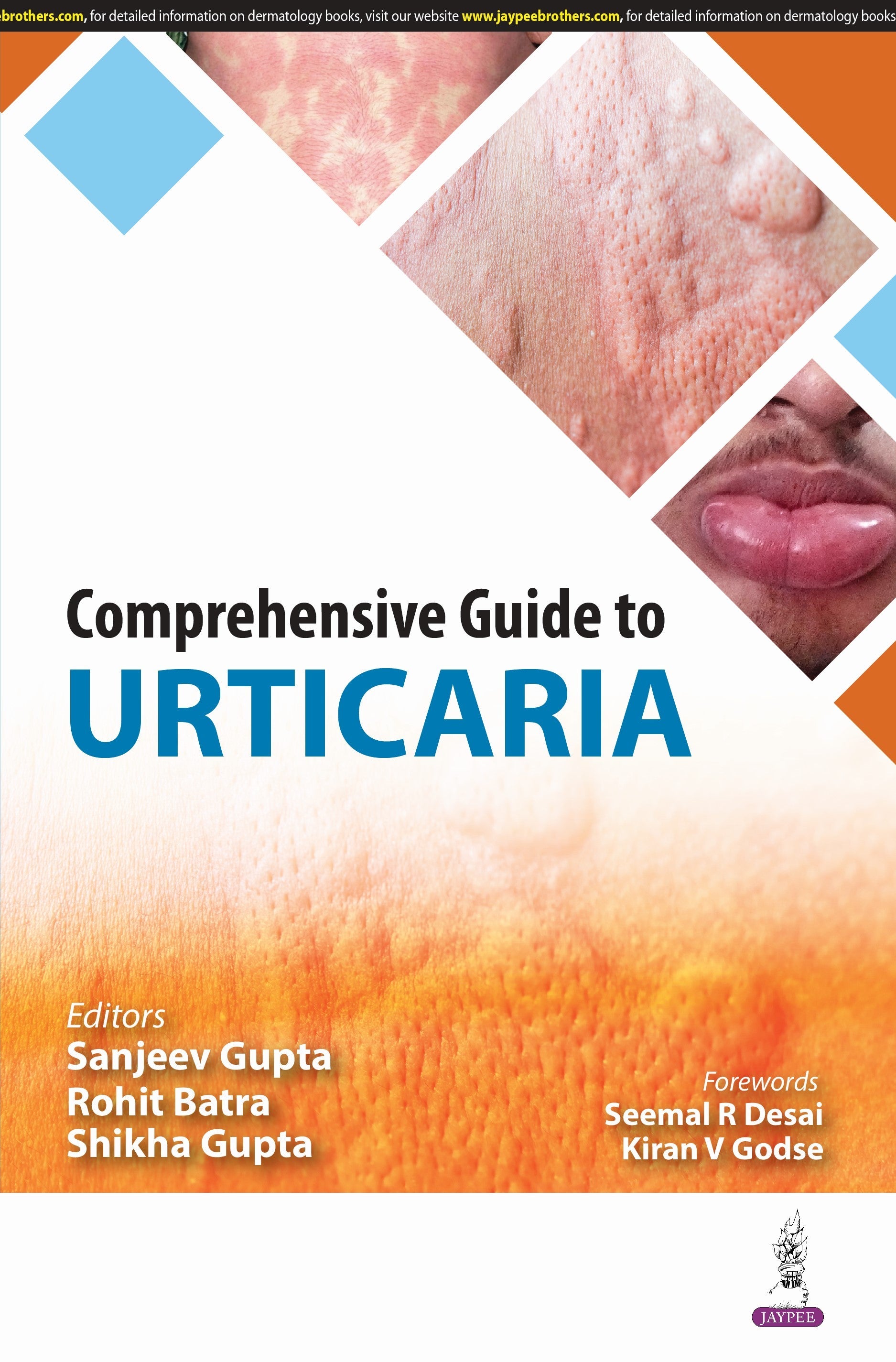 COMPREHENSIVE GUIDE TO URTICARIA