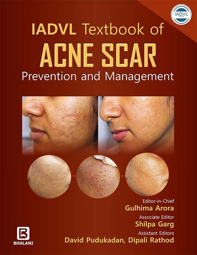 IADVL Textbook Of Acne Scar Prevention And  Management