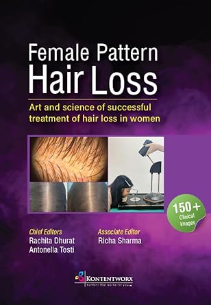 Female Pattern  Hair Loss