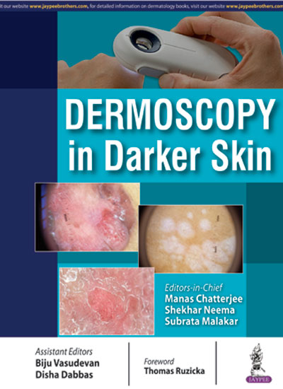 DERMOSCOPY IN DARKER SKIN
