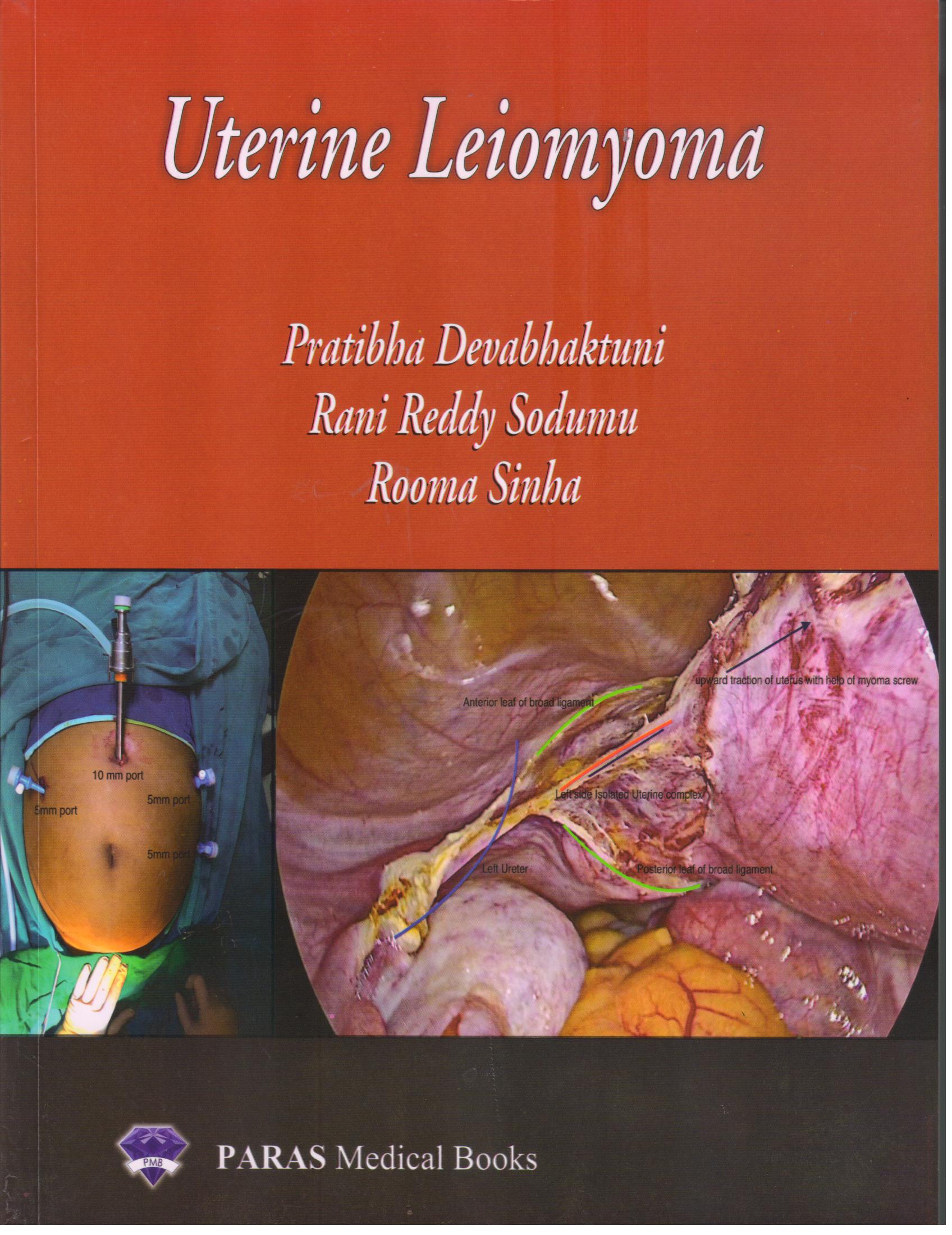 Uterine Leiomyoma