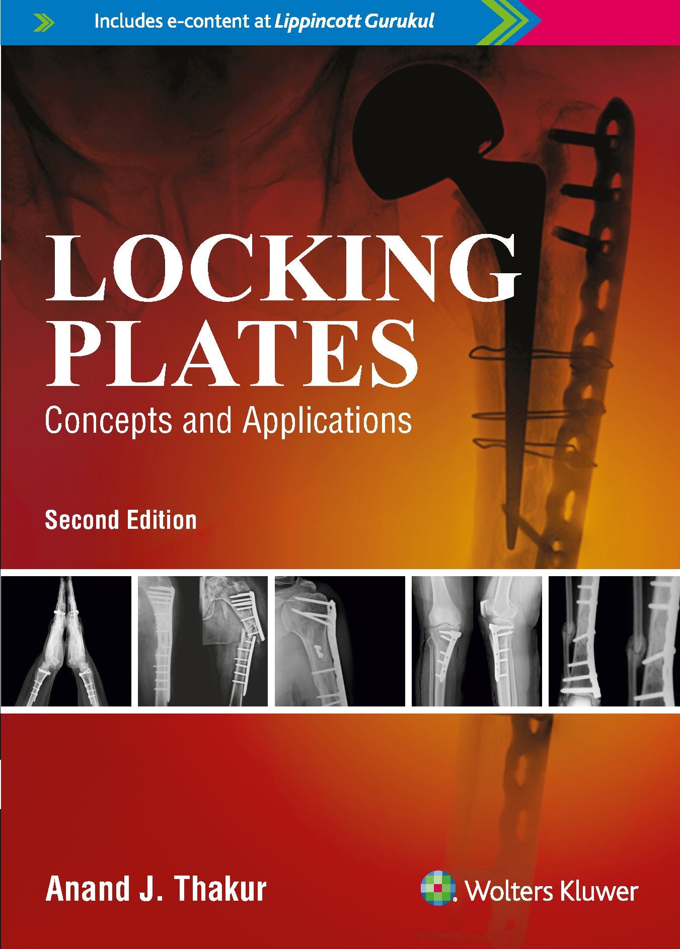 Locking Plates: Concepts and Applications, 2ed