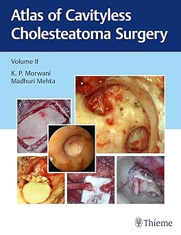 Atlas of Cavityless Cholesteatoma Surgery (Volume 2)