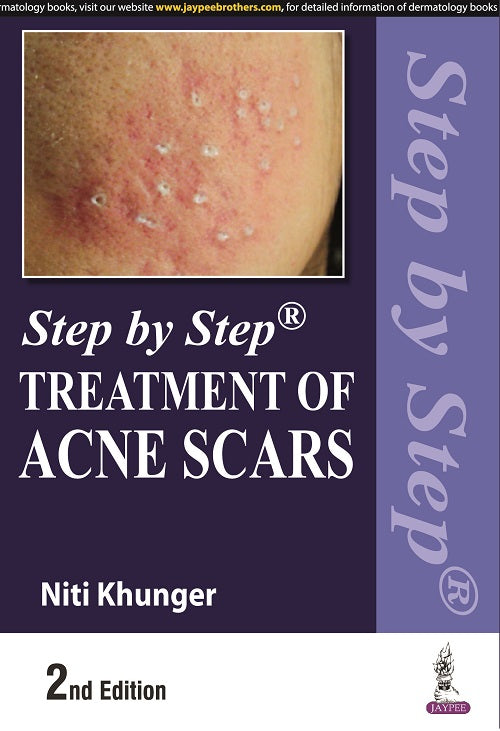 STEP BY STEP TREATMENT OF ACNE SCARS
