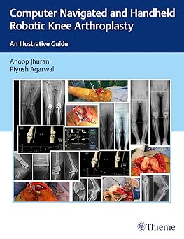 Computer Navigated and Hand Held Robotic Knee Arthroplasty: An Illustrative Guide, 1/e